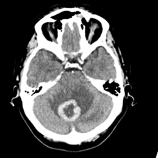 Cerebellar metastasis (Radiopaedia 54578-60812 Axial C+ 15).png