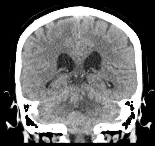 File:Cerebellar metastasis (Radiopaedia 54578-60812 Coronal non-contrast 37).png