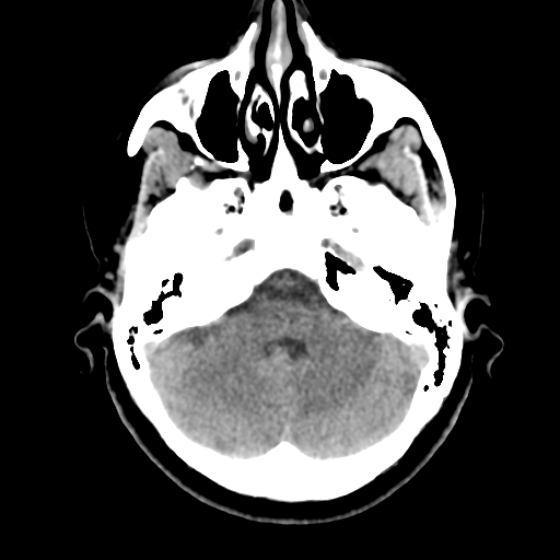 Cerebellar metastasis (cystic appearance) (Radiopaedia 41395-44258 Axial non-contrast 14).png