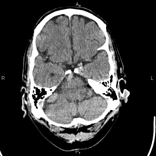 Cerebellopontine angle arachnoid cyst (Radiopaedia 85149-100704 Axial With contrast 11).jpg