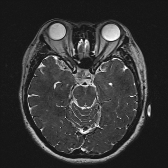 File:Cerebellopontine angle meningioma (Radiopaedia 53561-59591 Axial 3D volume T2 92).jpg