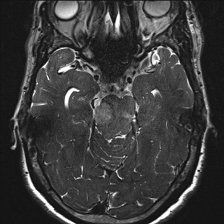Cerebellopontine angle meningioma (Radiopaedia 72983-83680 Axial FIESTA 60).jpg