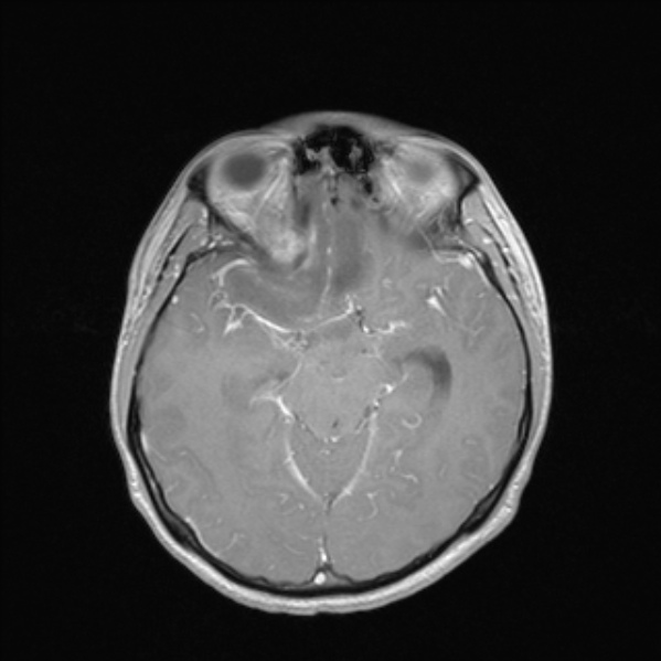 Cerebral abscess (Radiopaedia 24212-24478 Axial T1 C+ 27).jpg