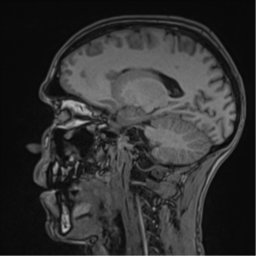 Cerebral abscess (Radiopaedia 60342-68009 Sagittal T1 24).png