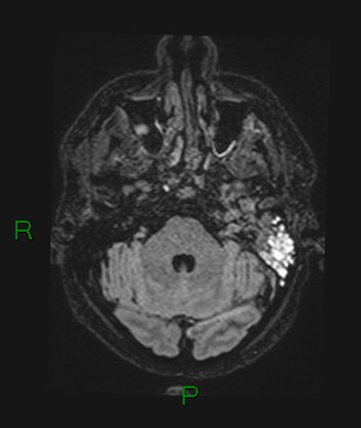 Cerebral abscess and subdural empyema (Radiopaedia 84436-99779 Axial FLAIR 64).jpg