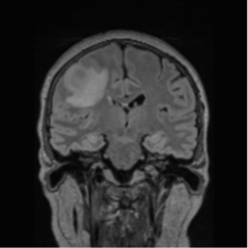 Cerebral abscess from pulmonary arteriovenous malformation (Radiopaedia 86275-102291 Coronal FLAIR 43).png
