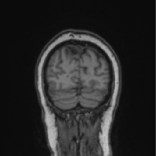 Cerebral abscess from pulmonary arteriovenous malformation (Radiopaedia 86275-102291 Coronal T1 16).png
