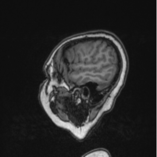Cerebral abscess from pulmonary arteriovenous malformation (Radiopaedia 86275-102291 Sagittal T1 80).png
