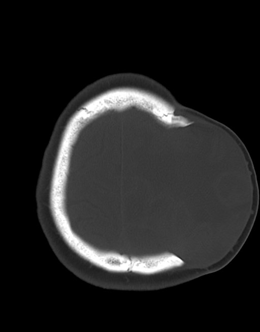 Cerebral abscesses (Radiopaedia 70458-80568 Axial bone window 51).jpg