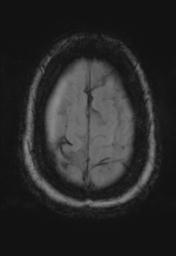File:Cerebral amyloid angiopathy (Radiopaedia 29129-29518 Axial SWI Magnitude 33).jpg