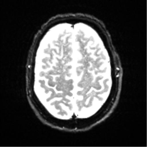 Cerebral amyloid angiopathy (Radiopaedia 46082-50433 Axial DWI 21).png