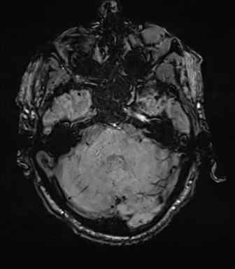 File:Cerebral amyloid angiopathy (Radiopaedia 46082-50433 Axial SWI 20).png