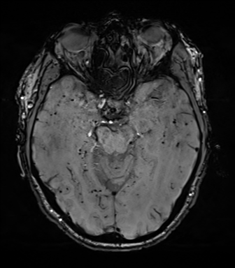 File:Cerebral amyloid angiopathy (Radiopaedia 46082-50433 Axial SWI 31).png