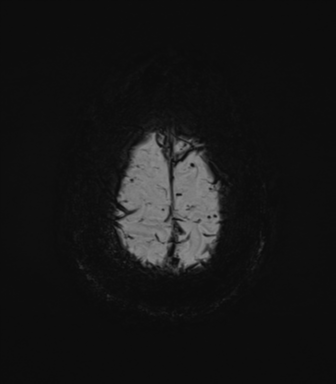 Cerebral amyloid angiopathy (Radiopaedia 46082-50433 Axial SWI MIP 74).png