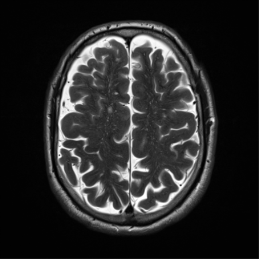 File:Cerebral amyloid angiopathy (Radiopaedia 46082-50433 Axial T2 27).png