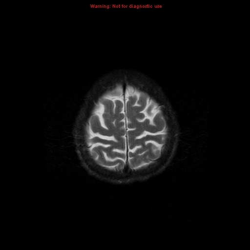 File:Cerebral and orbital tuberculomas (Radiopaedia 13308-13311 Axial T2 19).jpg