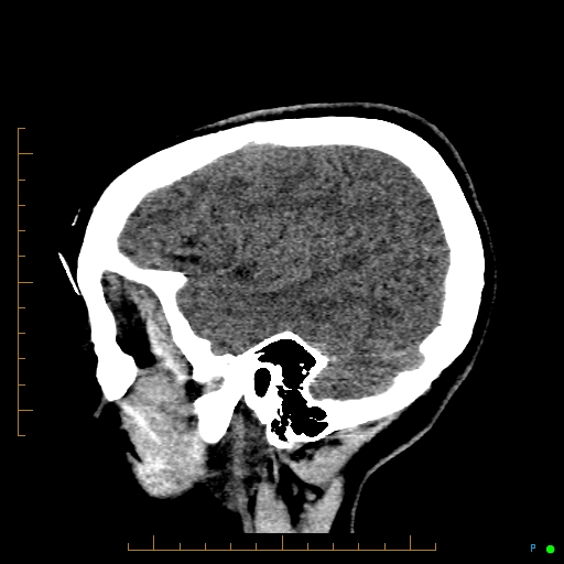 Cerebral arteriovenous malformation (AVM) (Radiopaedia 78162-90706 A 16).jpg
