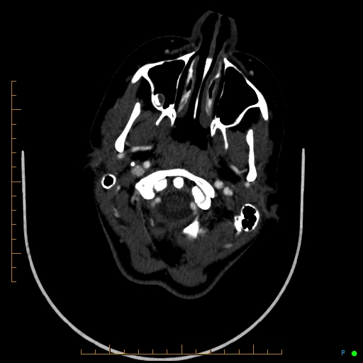 Cerebral arteriovenous malformation (AVM) (Radiopaedia 78162-90706 Axial CTA 41).jpg