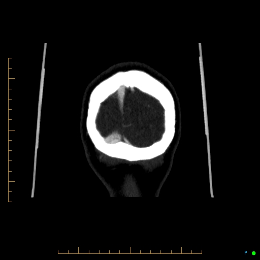 Cerebral arteriovenous malformation (AVM) (Radiopaedia 78162-90706 Coronal CTA 11).jpg