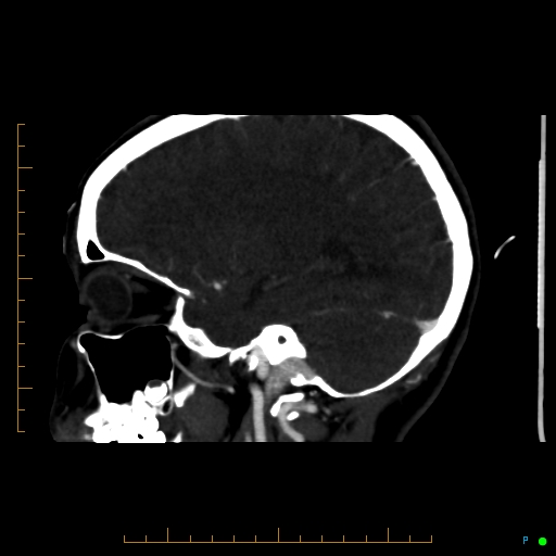 Cerebral arteriovenous malformation (AVM) (Radiopaedia 78162-90706 Sagittal CTA 54).jpg