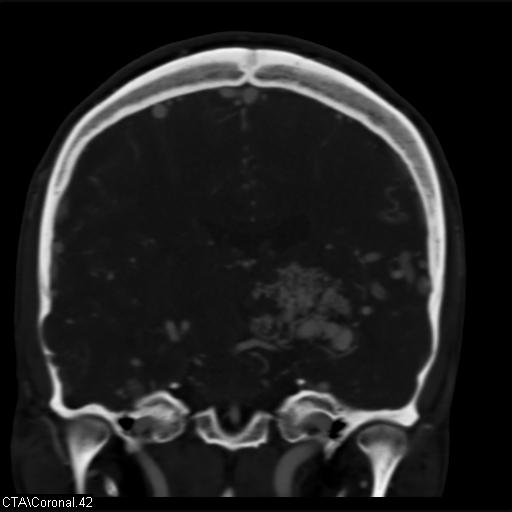 Cerebral arteriovenous malformation (Radiopaedia 28518-28759 C 42).jpg