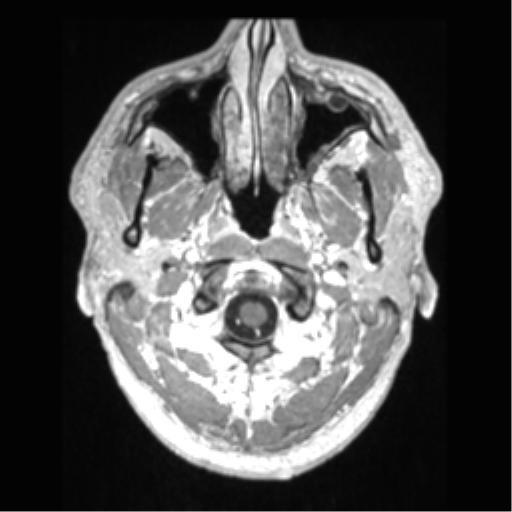 File:Cerebral arteriovenous malformation (Radiopaedia 39259-41506 AX T1 MPR C+ 1).png