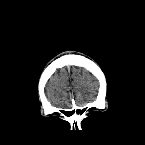 Cerebral arteriovenous malformation (Radiopaedia 61964-70028 Coronal non-contrast 7).jpg