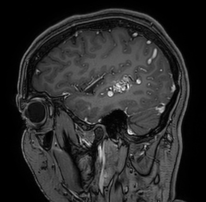 Cerebral arteriovenous malformation (Radiopaedia 74411-85654 Sagittal T1 C+ 25).jpg