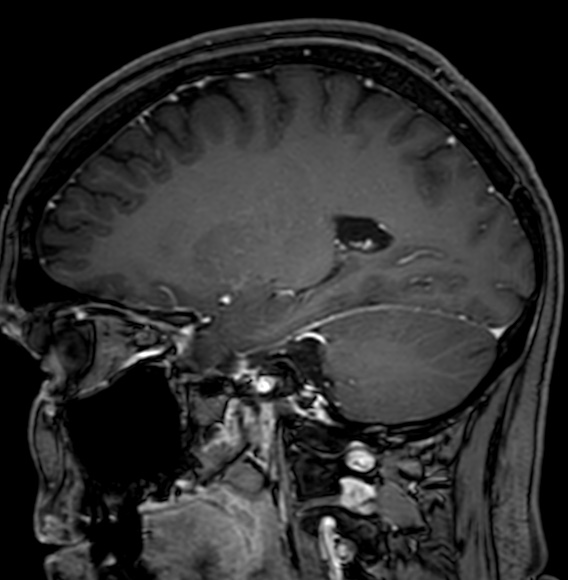 Cerebral arteriovenous malformation (Radiopaedia 74411-85746 Sagittal T1 C+ 44).jpg