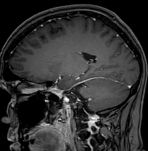 Cerebral arteriovenous malformation (Radiopaedia 74411-85746 Sagittal T1 C+ 48).jpg