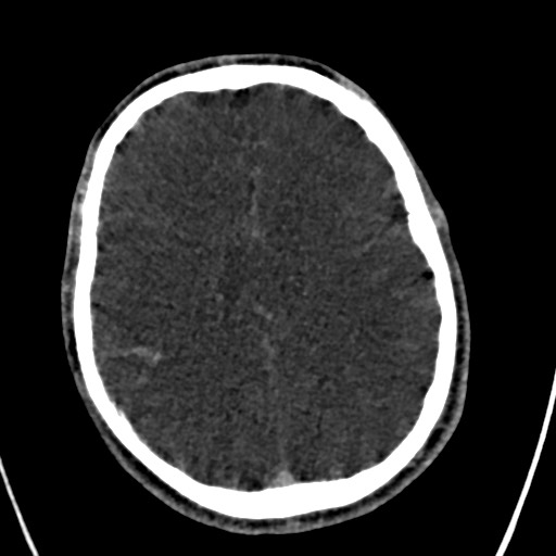 Cerebral arteriovenous malformation (Radiopaedia 78188-90746 Axial C+ delayed 114).jpg