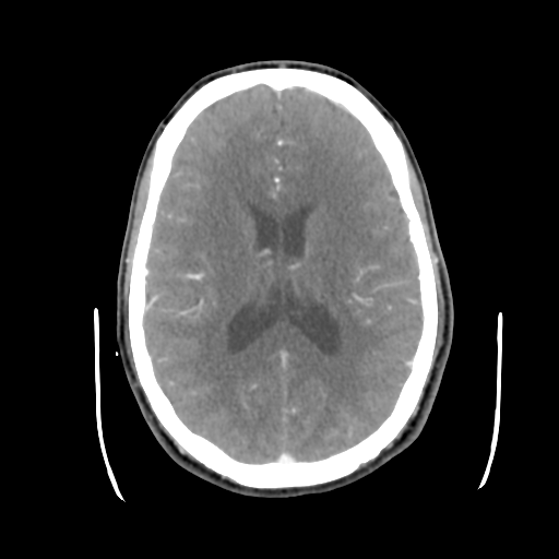 Cerebral arteriovenous malformation (Spetzler-Martin grade 2) (Radiopaedia 41262-44076 Axial C+ 30).png