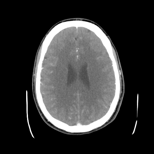 Cerebral arteriovenous malformation (Spetzler-Martin grade 2) (Radiopaedia 41262-44076 Axial C+ 33).png