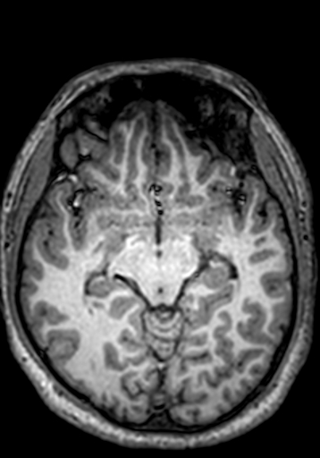 Cerebral arteriovenous malformation at posterior body of corpus callosum (Radiopaedia 74111-84925 Axial T1 176).jpg