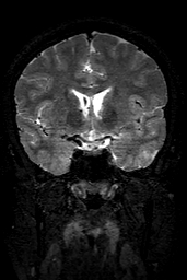 Cerebral arteriovenous malformation at posterior body of corpus callosum (Radiopaedia 74111-84925 Coronal T2 72).jpg