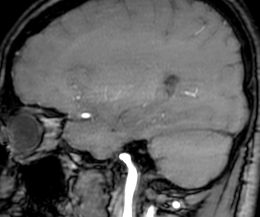 File:Cerebral arteriovenous malformation at posterior body of corpus callosum (Radiopaedia 74111-84925 J 107).jpg