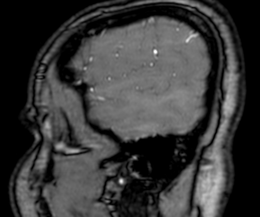 Cerebral arteriovenous malformation at posterior body of corpus callosum (Radiopaedia 74111-84925 J 18).jpg