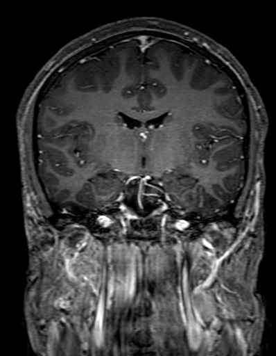 Cerebral arteriovenous malformation at posterior body of corpus callosum (Radiopaedia 74111-84925 K 177).jpg