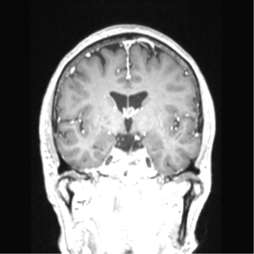 Cerebral arteriovenous malformation with hemorrhage (Radiopaedia 34422-35737 Coronal T1 C+ 52).png