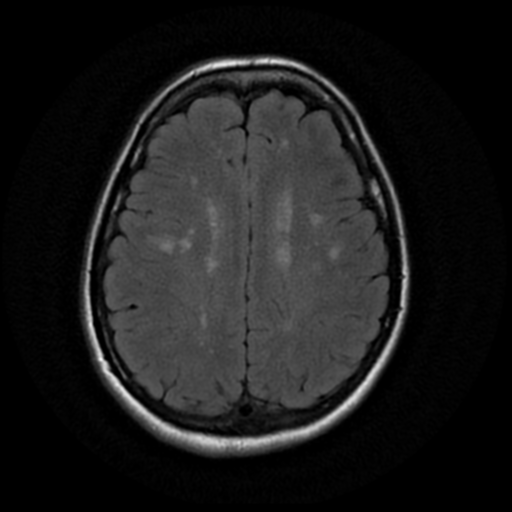File:Cerebral autosomal dominant arteriopathy with subcortical infarcts and leukoencephalopathy (CADASIL) (Radiopaedia 41018-43763 Ax T2 Flair PROP 14).png
