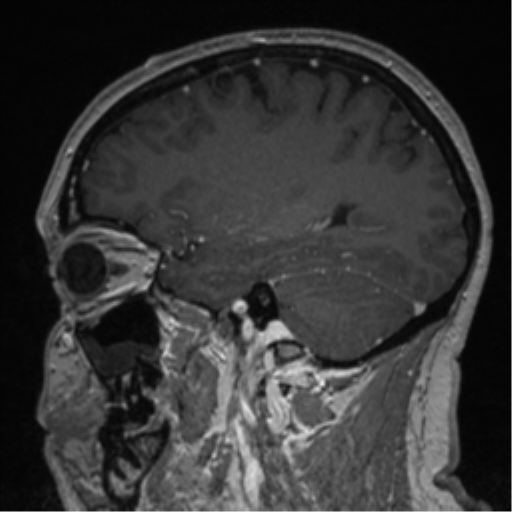 Cerebral cavernoma and development venous anomaly (Radiopaedia 37603-39482 Sagittal T1 C+ 33).png