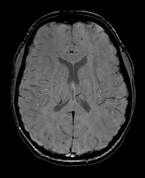 File:Cerebral cavernous venous malformation (Radiopaedia 70008-80021 I 43).jpg