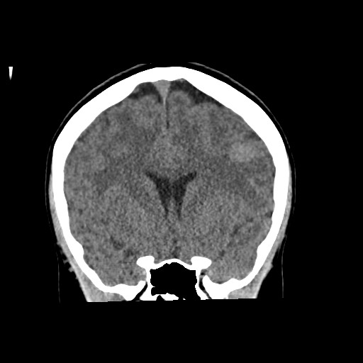 Cerebral cavernous venous malformation (Radiopaedia 70008-80022 non-contrast 29).jpg