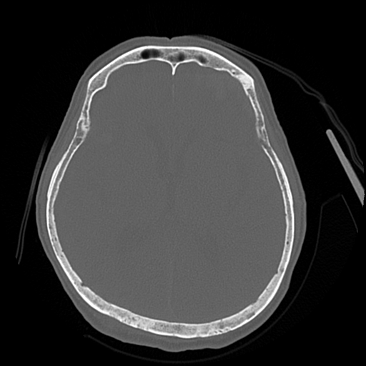 Cerebral contusions, subarachnoid hemorrhage and subdural hygromas (Radiopaedia 55399-61827 Axial bone window 28).png