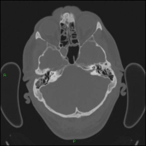 Cerebral contusions (Radiopaedia 33868-35039 Axial bone window 43).jpg