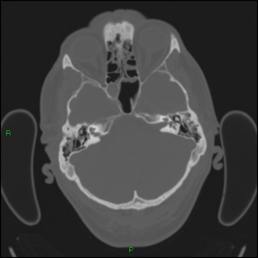 Cerebral contusions (Radiopaedia 33868-35039 Axial bone window 45).jpg