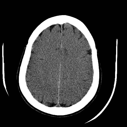 File:Cerebral edema (evolution in time) (Radiopaedia 19418-19440 non-contrast 70).jpg
