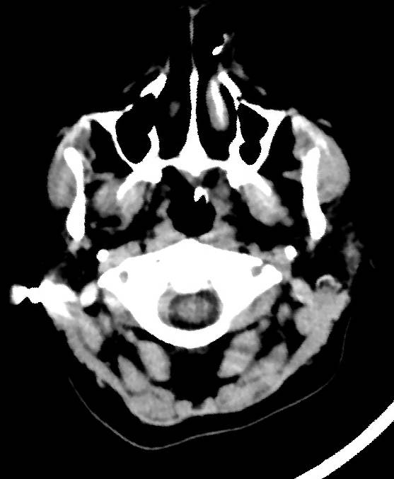 Cerebral edema due to severe hyponatremia (Radiopaedia 89826-106937 Axial non-contrast 1).jpg