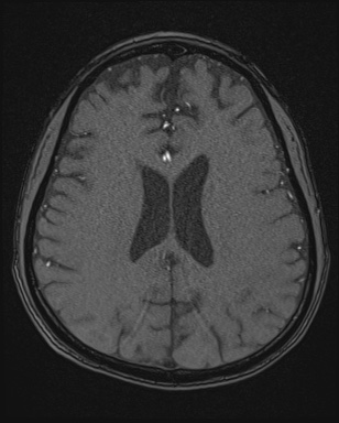 Cerebral embolic infarcts (embolic shower) (Radiopaedia 72391-82921 Axial MRA 128).jpg