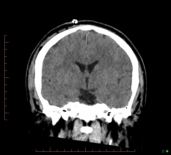 Cerebral fat embolism (Radiopaedia 85521-101224 Coronal non-contrast 31).jpg